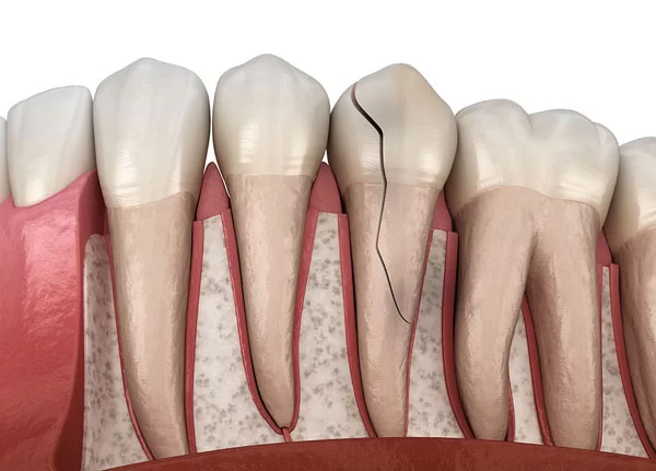 tooth fractures